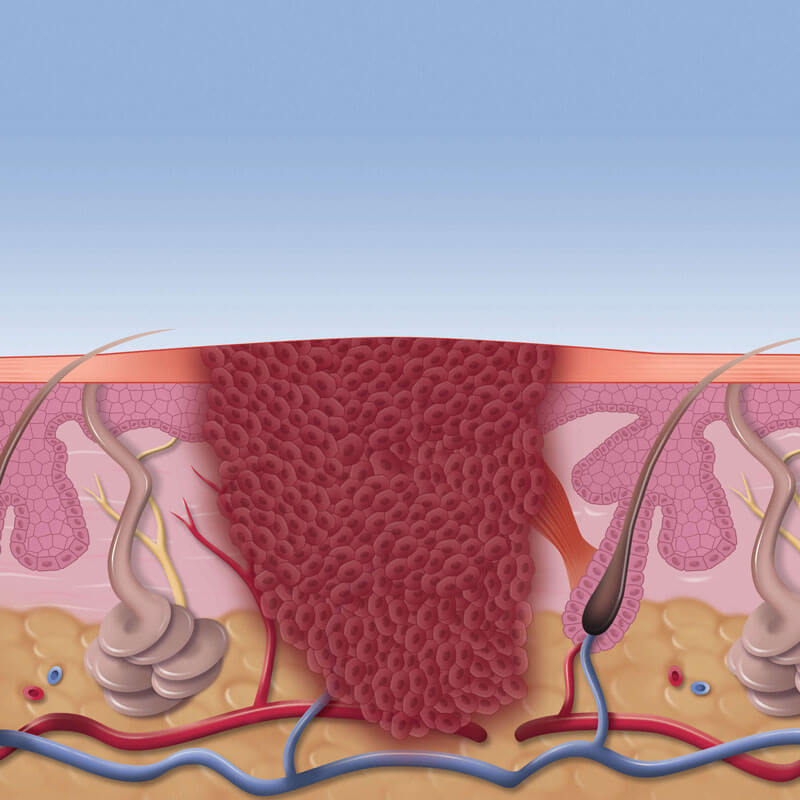 Infected Tissue